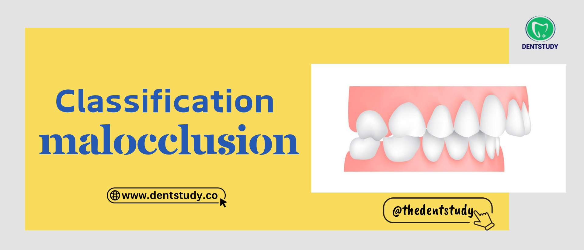 CLASSIFICATION OF MALOCCLUSION- ORTHODONTICS