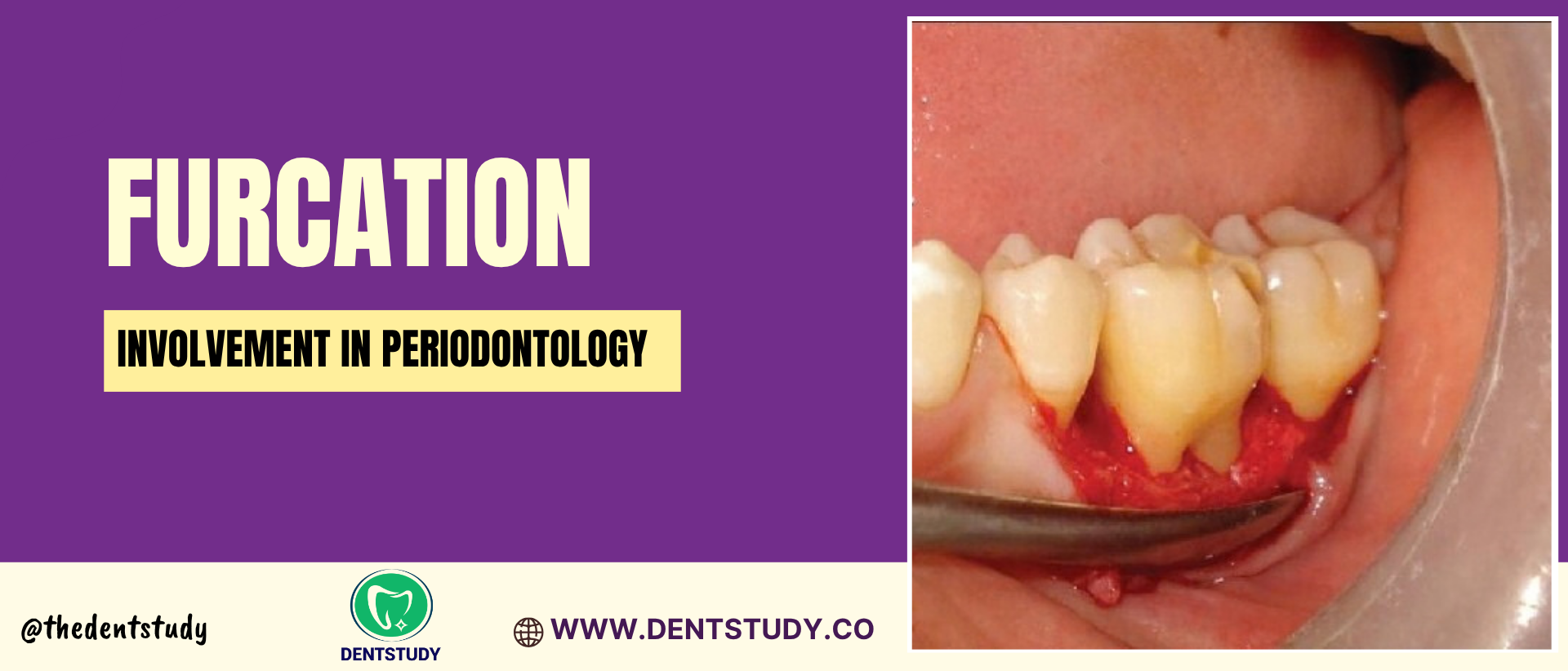 FURCATION INVOLVEMENT IN PERIODONTOLOGY