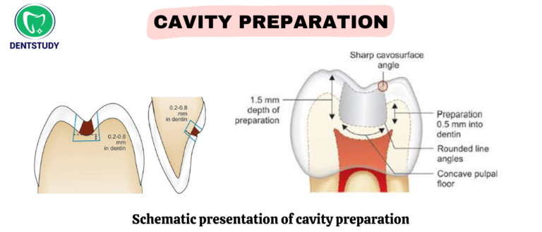 Cavity Preparation  in Conservative Dentistry