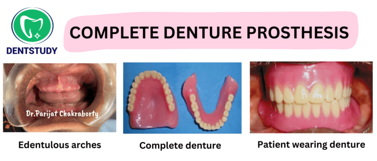 Complete Denture Preparation for Exam