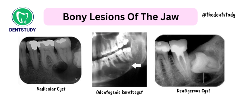 BONY LESIONS OF THE JAW