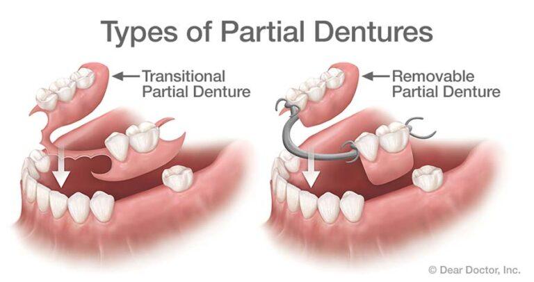 IMPORTANT VIVA QUESTIONS PROSTHODONTICS