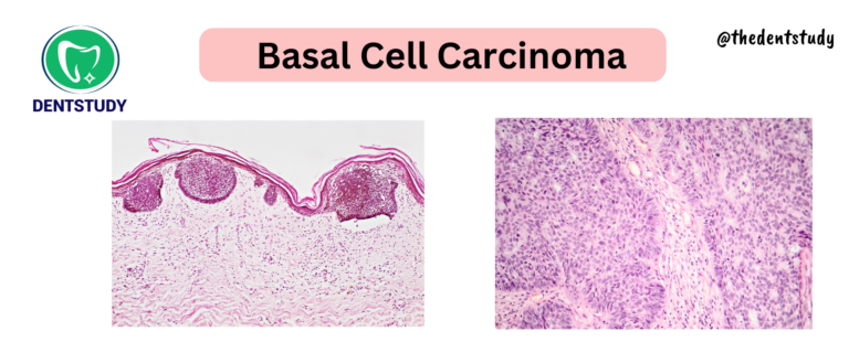 QUICK STUDY NOTES – BASAL CELL CARCINOMA