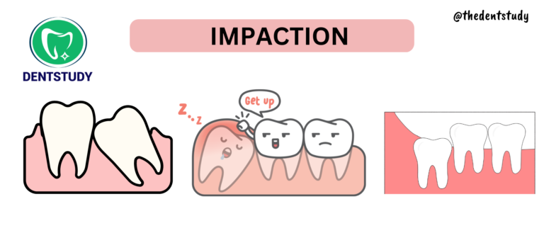 Tooth Impaction Viva Questions for Exams