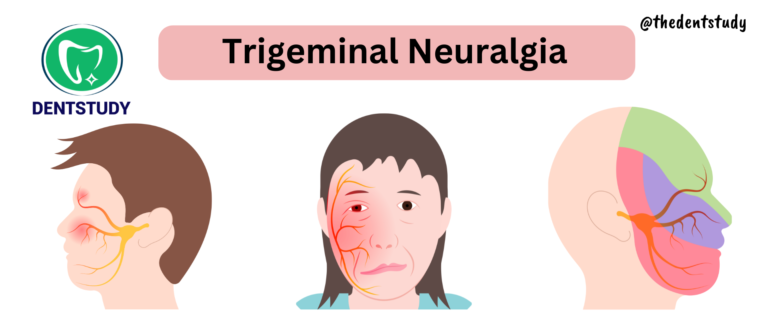 Sensory Disturbances Of Face and Jaws -Trigeminal Neuralgia